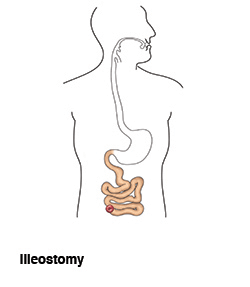 illeostomy-ostomy-illustration